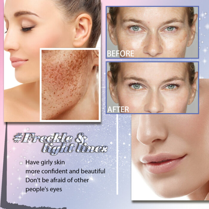Freckle Removing Anti-aging Essence, Facial Firming Anti-wrinkle Lightening Melasma Stain Nourishing Skin Essence - Image 4