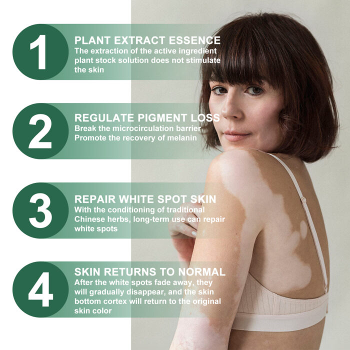 Vitiligo Relief Cream, Repair White Spots Flower Spots Skin Topical Care Ointment - Image 4