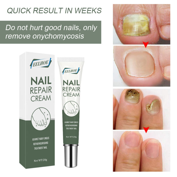 Foot Care And Thickening Nail Repair Cream. Nail Repair Cream - Image 4