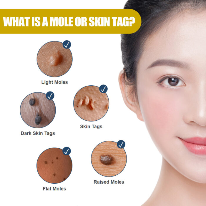 Wart Essence Removes Dark Moles Flesh Moles Repair Skin Neck Flesh Grains Flat Especially Corns Remove Warts - Image 4