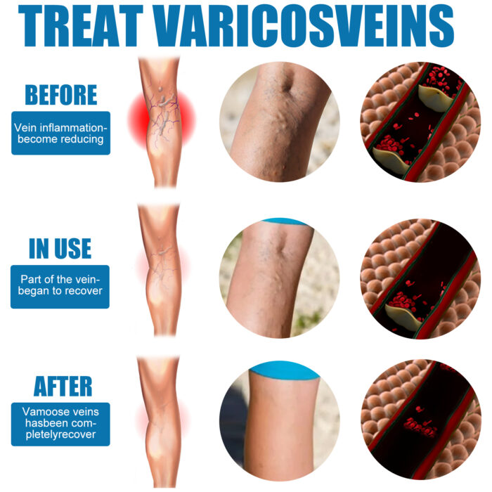 Leg Care Spray Gently Relieve Leg Discomfort, Blue Veins And Bumps Repair Daily Care - Image 4