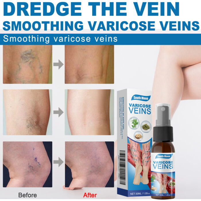 Leg Care Spray Gently Relieve Leg Discomfort, Blue Veins And Bumps Repair Daily Care - Image 5