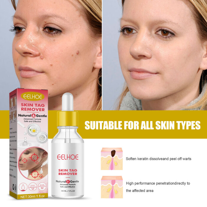 Wart Essence Removes Dark Moles Flesh Moles Repair Skin Neck Flesh Grains Flat Especially Corns Remove Warts